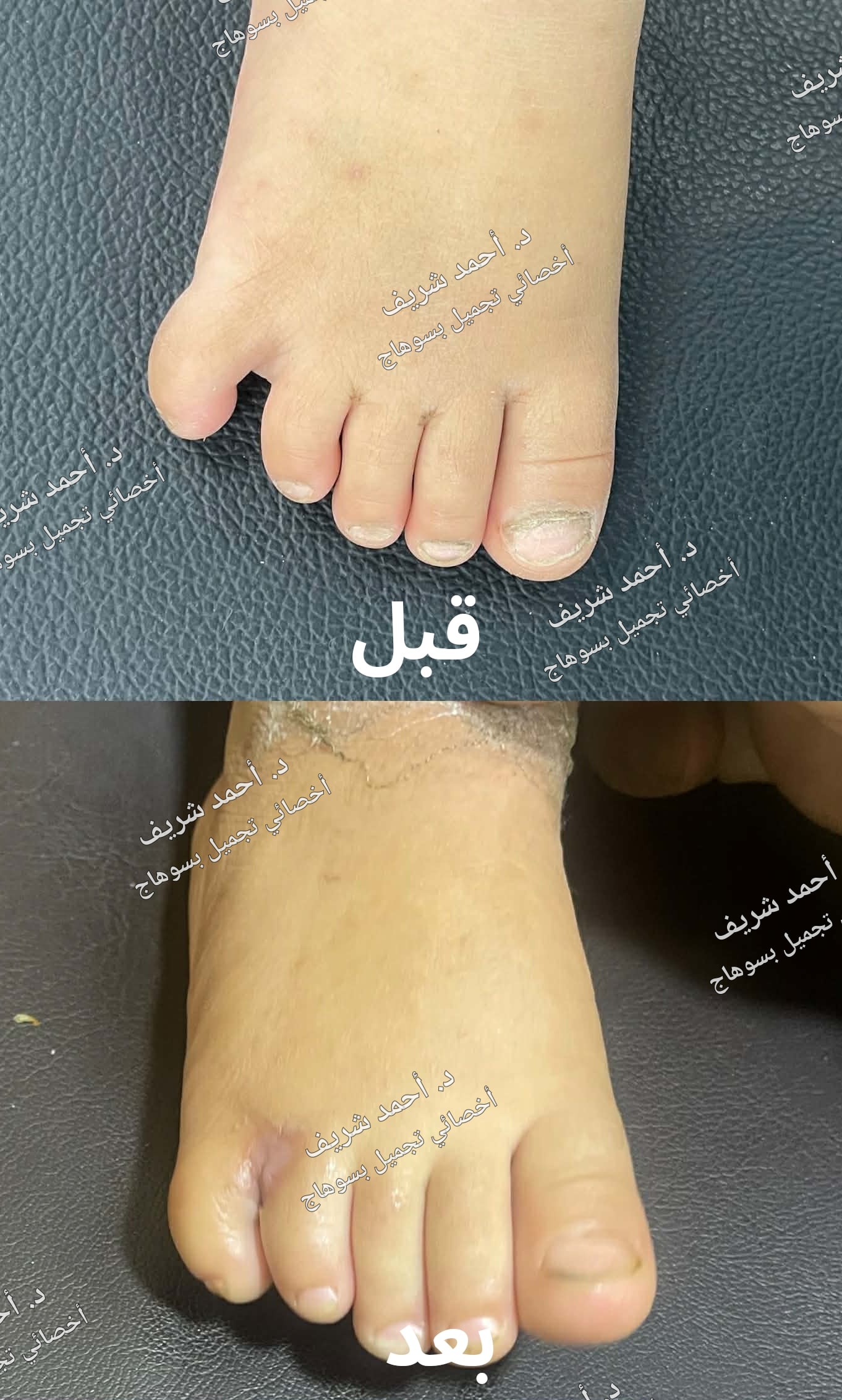 تشوهات أصابع اليد والقدمين — صورة 1