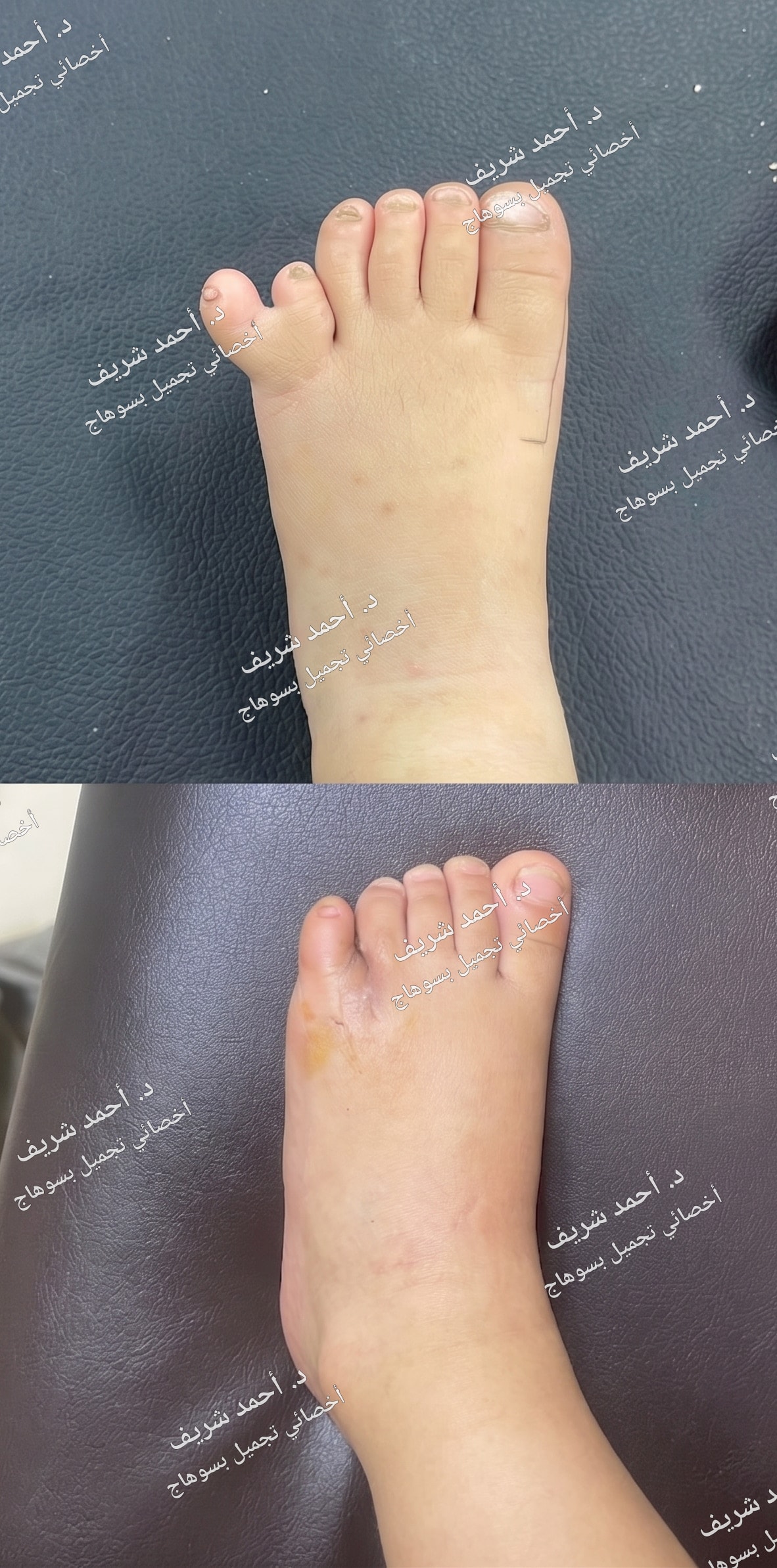 تشوهات أصابع اليد والقدمين — صورة 2