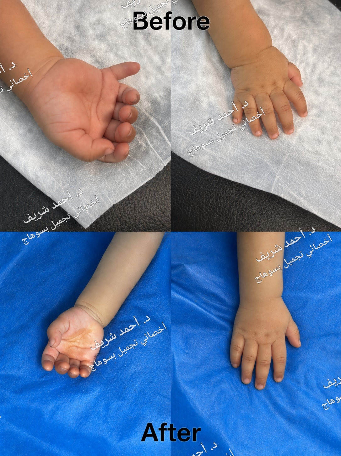 تشوهات أصابع اليد والقدمين — صورة 3