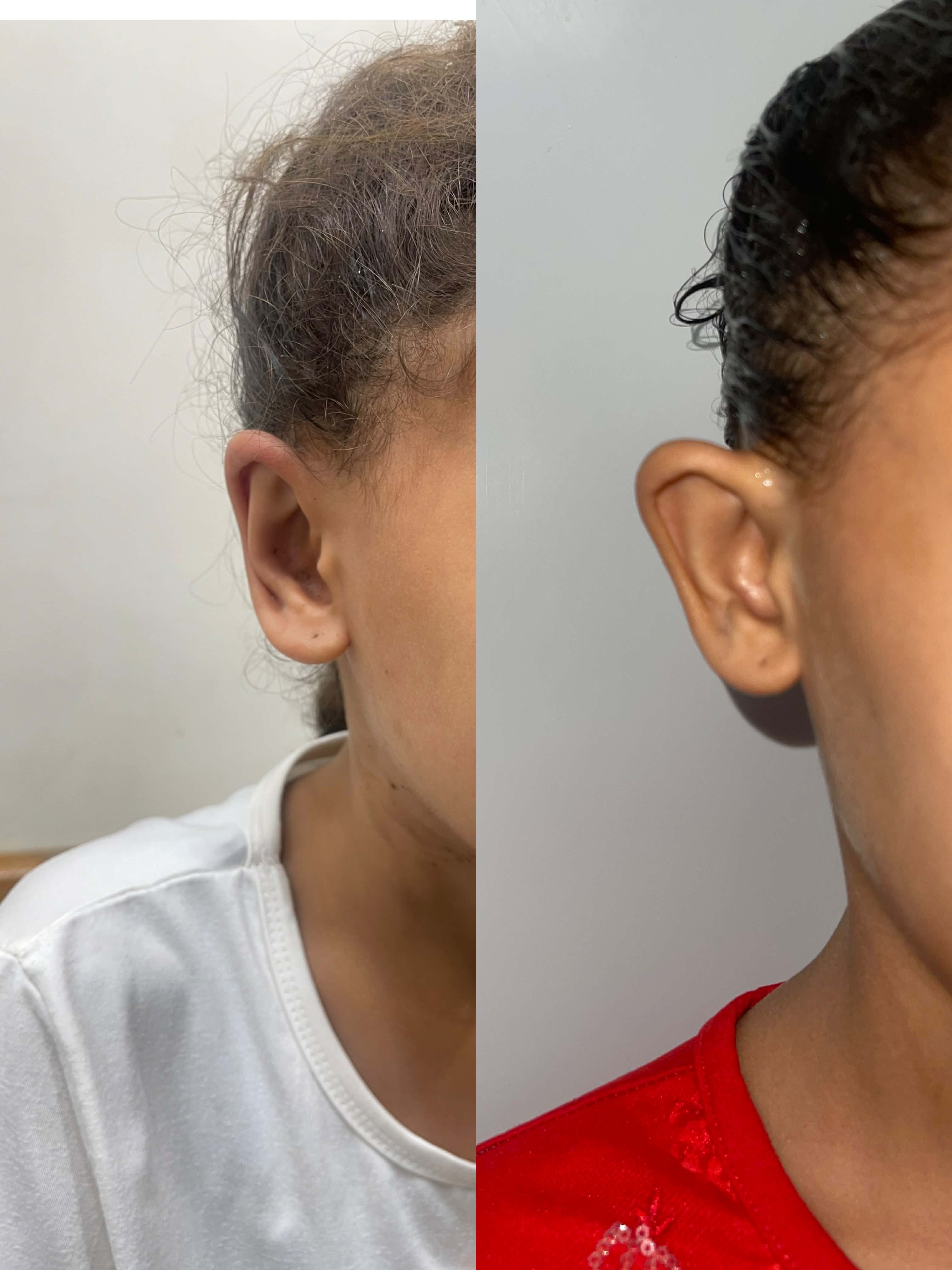 تجميل الأذن — صورة 1